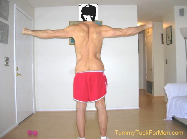 In this photograph you can see the sagging and wrinkled skin on my hips and buttocks. I was hoping that having a lateral thigh lift with my tummy tuck operation would solve this problem. Note: for my operation they extended the incision line along the sides and back and removed the sagging skin from around my entire mid-section. tummytuckformen.com