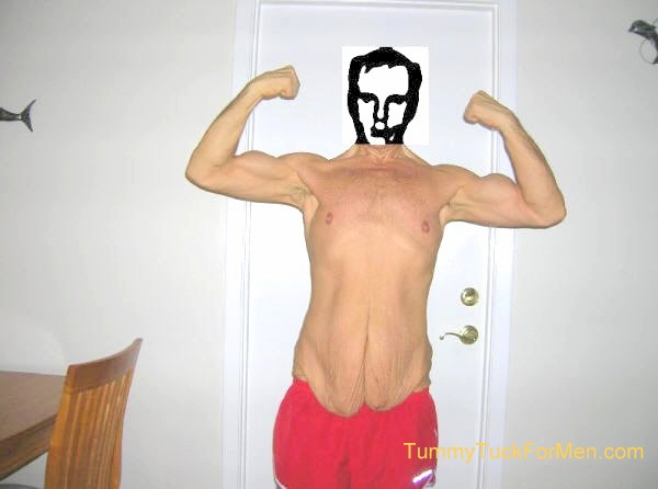 How I lost 150 Pounds Before My Tummy Tuck