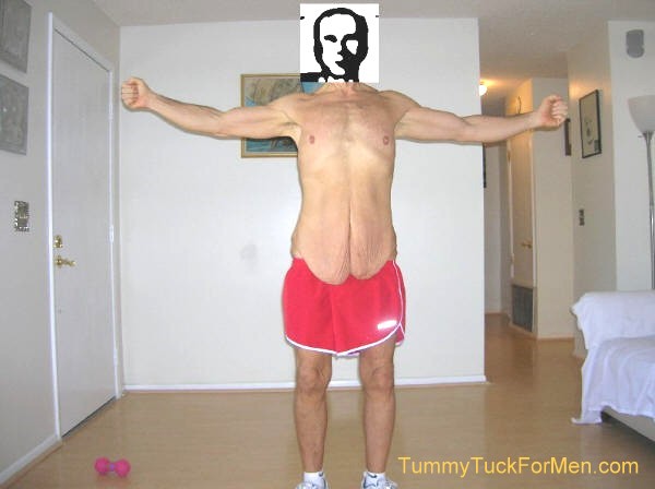 In this photograph you can see the sagging and wrinkled skin on my hips and buttocks. I was hoping that having a lateral thigh lift with my tummy tuck operation would solve this problem. Note: for my operation they extended the incision line along the sides and back and removed the sagging skin from around my entire mid-section. tummytuckformen.com