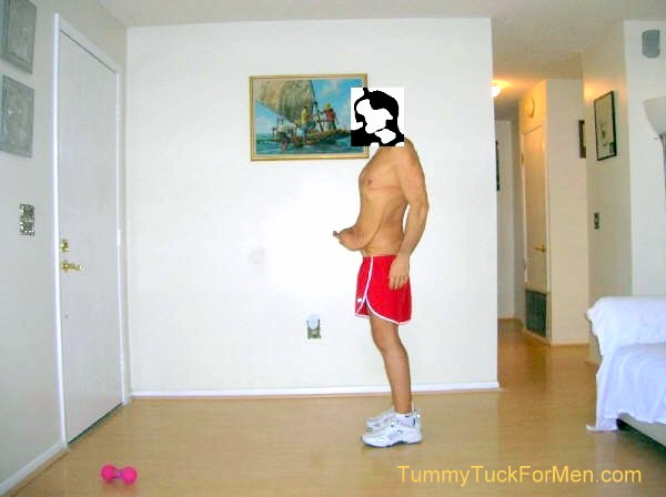 In this photograph you can see the sagging and wrinkled skin on my belly, hips and buttocks. I was hoping that having a lateral thigh lift with my tummy tuck operation would solve this problem. Note: for my operation they extended the incision line along the sides and back and removed the sagging skin from around my entire mid-section. tummytuckformen.com