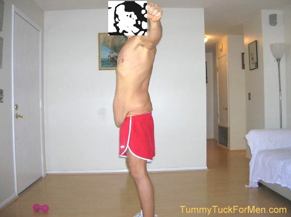 In this photograph you can see the sagging and wrinkled skin on my hips and buttocks. I was hoping that having a lateral thigh lift with my tummy tuck operation would solve this problem. Note: for my operation they extended the incision line along the sides and back and removed the sagging skin from around my entire mid-section. tummytuckformen.com