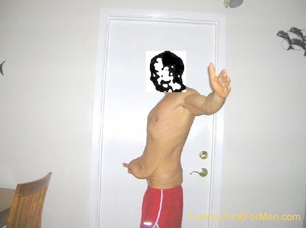 This is a photograph of how I looked from the left before undergoing Tummy Tuck Abdominoplasty Plastic Surgery with Lateral Thigh Lift to remove excess hanging skin from my midsection (having lost over 100 lbs). 