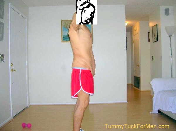 In this photograph you can see the sagging and wrinkled skin on my hips and belly. I was hoping that having a lateral thigh lift with my tummy tuck operation would solve this problem. Note: for my operation they extended the incision line along the sides and back and removed the sagging skin from around my entire mid-section. tummytuckformen.com