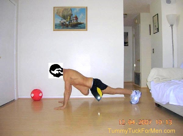 This is a photograph of how I looked from the left before undergoing Tummy Tuck Abdominoplasty Plastic Surgery with Lateral Thigh Lift to remove excess hanging skin from my midsection (having lost over 100 lbs). tummytuckformen.com