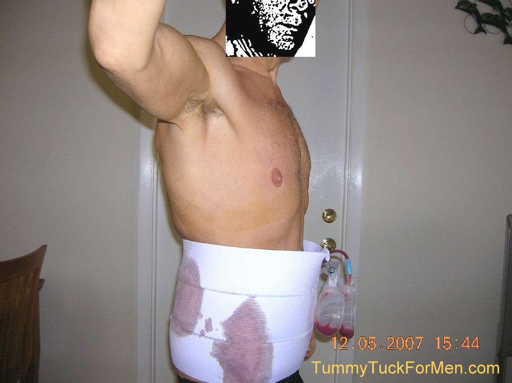 One day after surgery