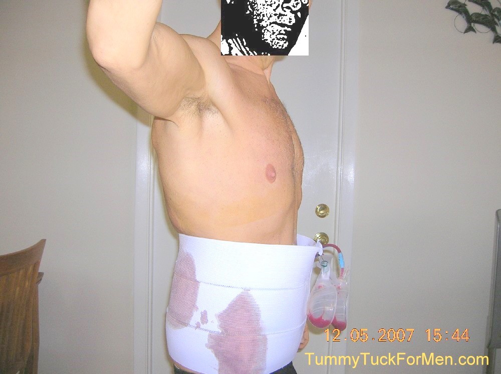 Tummy Tuck Procedure