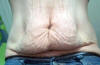 Fleur De Lis Abdominoplasty