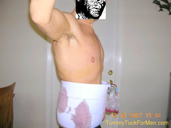 Tummy Tuck (Abdominoplasty) for a Guy. I am a guy who had a Tummy Tuck operation. This is my personal story of having Tummy Tuck Plastic Surgery (Abdominoplasty) with Lateral Thigh Lift including Before & After pictures and a daily log of my pre-operation, day of surgery and post operation recovery experiences.