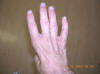 Muscle Atrophy and Weakness in Hand and Fingers Due to Pinched Ulnar Nerve