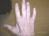 Open Hand with Muscle Atrophy - images/loss-of-muscle-meat-in-right-hand-caused-by-damage-to-the-ulnar-nerve_small.JPG