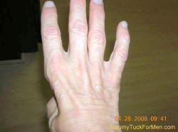 Undergoing Surgery For A Pinched Ulnar Nerve