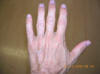 NO  MUSCLE ATROPHY in left hand - images/normal-left-hand-no-nerve-damage_small.JPG