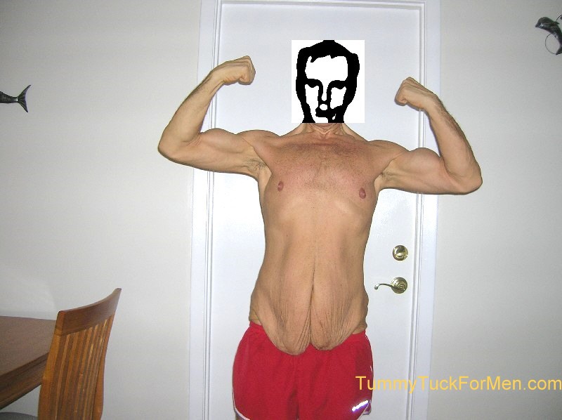 Skin Tuck Before Picture