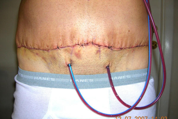 TUMMY TUCK SURGICAL DRAIN TUBES