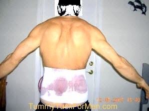 I am a 54 year old man who is 5' - 7 1/2" tall who had attained a weight of over 300 pounds. After over 2 years of dieting and daily exercise I reduced my weight to 155lbs. This left me with a lot of excess skin around my belly and mid section. Since I didn't want to live with this for the rest of my life, I decided to look into a Tummy Tuck operation. Read My Story and see my Before and After Photographs. tummytuckformen.com