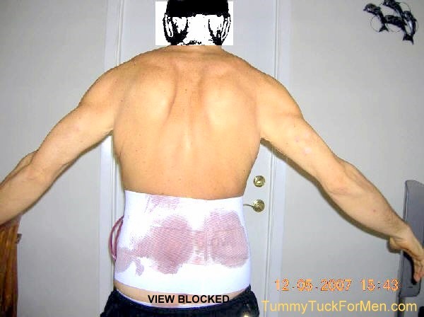 BODY LIFT; LATERAL THIGH LIFT FOR A MAN