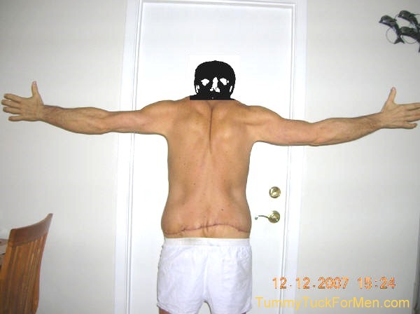 Zoomable "After" photograph of Tummy Tuck (Abdominoplasty) & Lateral Thigh Lift Surgery to remove sagging skin after a 150 pound weight loss. Tummy Tuck before and after picture gallery. Note the scars and swelling one week after surgery.tummytuckformen.com