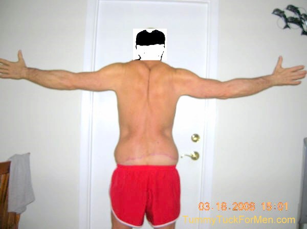 This photograph was taken three months after my tummy tuck with lateral thigh lift operation and shows the uneven incision line area on my back side. Healing was progressing nicely but I was starting to wonder if I still had swelling or if I should have lost 10 pounds more before I the operation. tummytuckformen.com