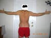 Plastic Surgery Scars After 3 months showing back side. tummytuckformen.com