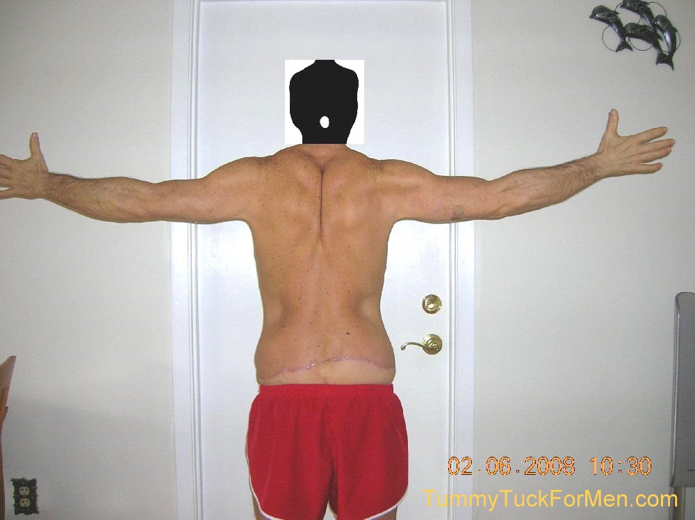 This photograph was taken two months after my tummy tuck with lateral thigh lift operation and shows the uneven incision line area on my back side. Healing was progressing nicely but I was starting to wonder if I still had swelling or if I should have lost 10 pounds more before I the operation. tummytuckformen.com