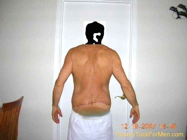 This photograph was taken two weeks after my tummy tuck with lateral thigh lift operation and shows the swelling and uneven incision line associated with the lateral thigh lift portion of my operation. The healing was progessing nicely but there was still obvious swelling. tummytuckformen.com