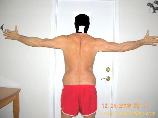 This photograph was taken one year after my tummy tuck with lateral thigh lift operation. My scars are still quite noticeable but are still fading slowly. I was lucky. I had no pain at all throughout my entire experience.