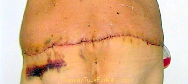 This photograph was taken two days after my tummy tuck with lateral thigh lift operation and shows the obvious swelling and bruising immediately after surgery. You can see how the skin is stretched and sewn together at the incision line. This is a good example of a lateral thigh lift surgery where the surgeon continues the incision to the buttocks area. Even though it looks ugly and painful, I experienced no pain. tummytuckformen.com