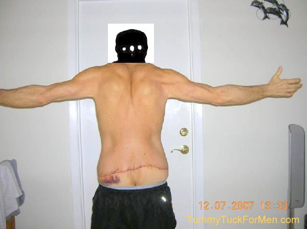This is a photograph of how I looked from the back 2 days after undergoing Tummy Tuck (Abdominoplasty) Plastic Surgery with Lateral Thigh Lift to remove excess hanging skin from my midsection (having lost over 100 lbs). tummytuckformen.com