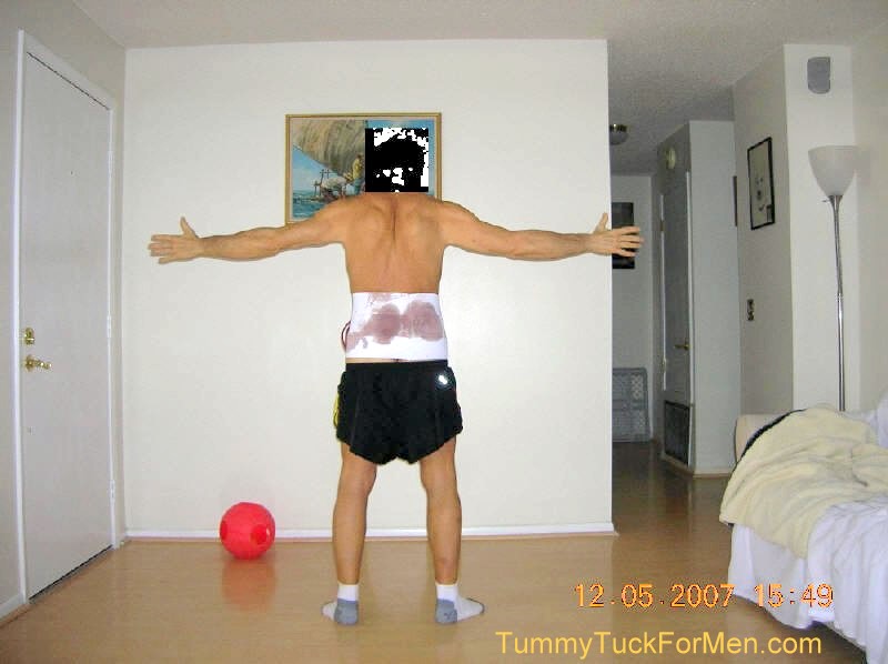 BODY LIFT, THIGH LIFT AFTER WEIGHT LOSS