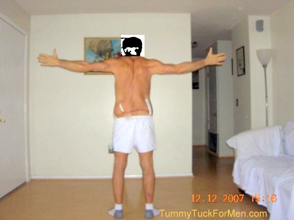 Zoomable "Before" photograph of Tummy Tuck (Abdominoplasty) & Lateral Thigh Lift Surgery to remove sagging skin after a 150 pound weight loss. Tummy Tuck before and after picture gallery. Note the scars and swelling one week after surgery. tummytuckformen.com