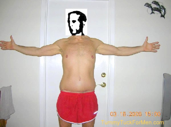 This is a photograph of how I looked from the front 3 months after undergoing Tummy Tuck (Abdominoplasty) Plastic Surgery with Lateral Thigh Lift to remove excess hanging skin from my midsection (having lost over 100 lbs).