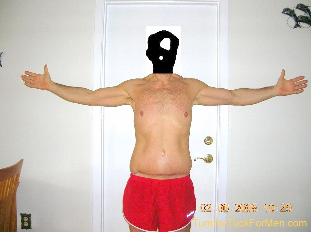 This photograph was taken two months after my tummy tuck with lateral thigh lift operation and shows the tummy tuck belly button and incision line area. I started to wonder if my waist was still swollen or if I should have lost 10 more pounds before the operation.