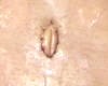 Tummy Tuck Pictures; Abdominoplasty Pictures, Thigh Lift Pictures - Tummy Tuck Abdominoplasty Plastic Surgery Belly Button showing stitches after 3 days. tummytuckformen.com