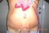 Surgical Drains - Day After Abdominoplasty Plastic Surgery showing surgical drain system. tummytuckformen.com