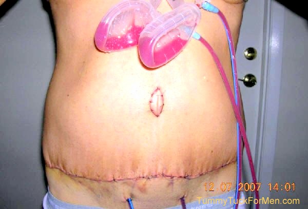 This is a photograph of how I looked 3 days after undergoing Tummy Tuck Abdominoplasty Plastic Surgery with Lateral Thigh Lift to remove excess hanging skin from my midsection (having lost over 100 lbs). Note the swelling, bruising, stitches and belly button. tummytuckformen.com