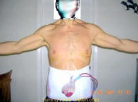 Tummy Tuck Healing - Healing After A Tummy Tuck