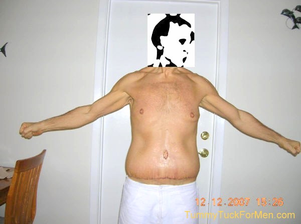 Zoomable "After" photograph of Tummy Tuck (Abdominoplasty) & Lateral Thigh Lift Surgery to remove sagging skin after a 150 pound weight loss. Tummy Tuck before and after picture gallery. Note the scars and swelling one week after surgery.tummytuckformen.com
