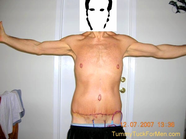 This photograph was taken three days after my tummy tuck with lateral thigh lift operation and shows how my surgical drains penetrate my body at two locations. It also shows what the belly button and incision line look like immediately after surgery. You can see how the skin is stretched and sewn together. The swelling is also obvious. tummytuckformen.com