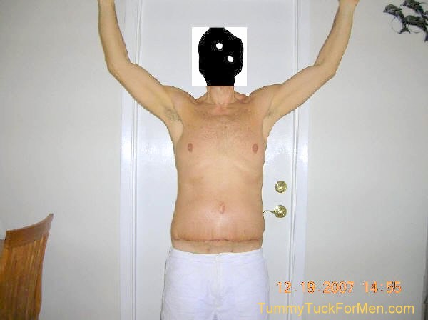 This is a photograph of how I looked from the front 2 weeks after undergoing Tummy Tuck (Abdominoplasty) Plastic Surgery with Lateral Thigh Lift to remove excess hanging skin from my midsection (having lost over 100 lbs). tummytuckformen.com