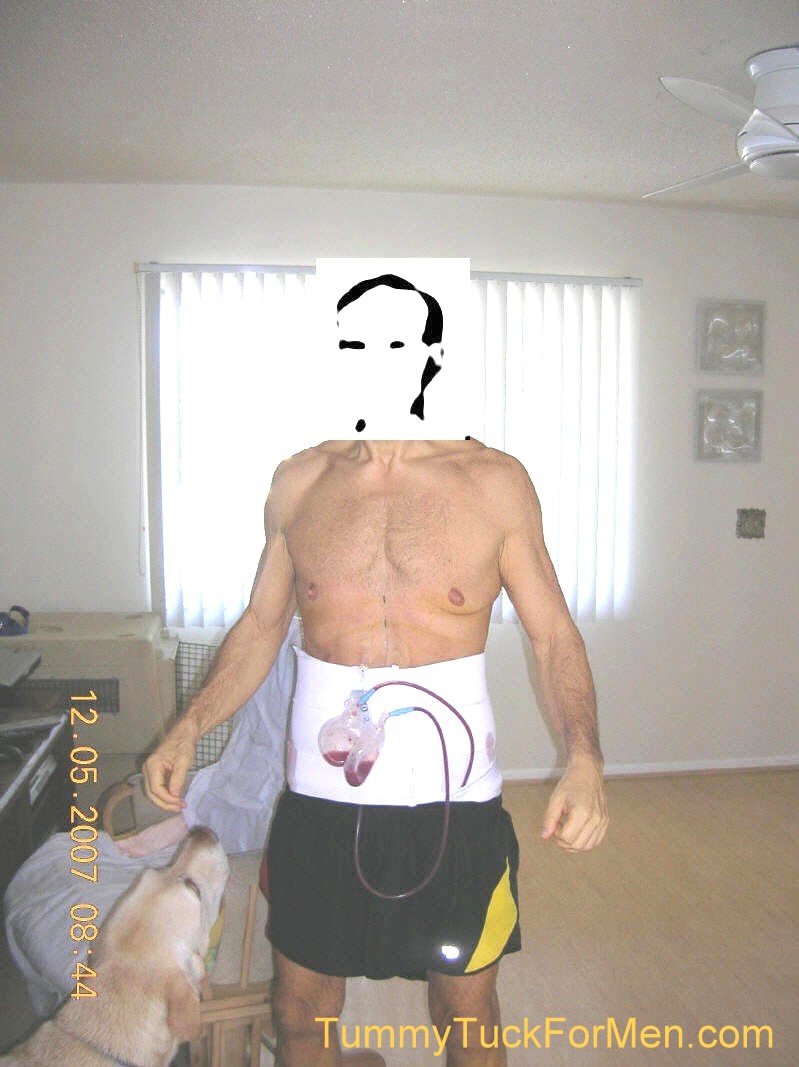 "Tummy Tuck" Plastic Surgery (Abdominoplasty) with Lateral Thigh Lift After 1 Day. tummytuckformen.com