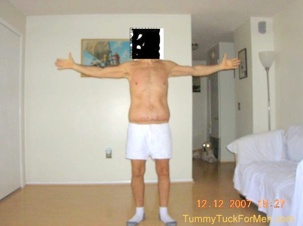 Zoomable "After" photograph of Tummy Tuck (Abdominoplasty) & Lateral Thigh Lift Surgery to remove sagging skin after a 150 pound weight loss. Tummy Tuck before and after picture gallery. Note the scars and swelling one week after surgery.tummytuckformen.com