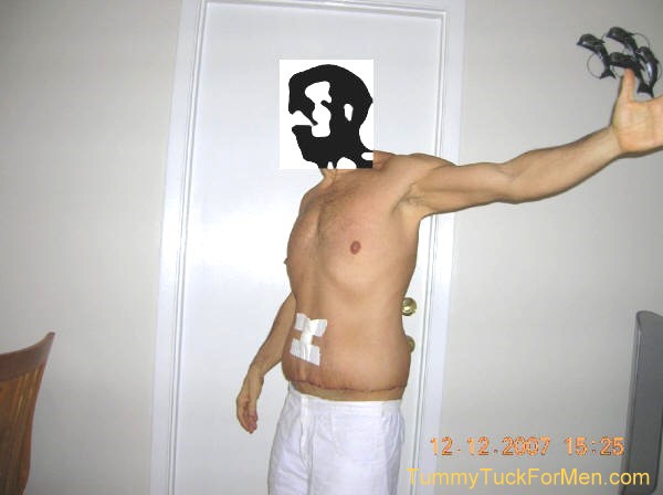 Zoomable "After" photograph of Tummy Tuck (Abdominoplasty) & Lateral Thigh Lift Surgery to remove sagging skin after a 150 pound weight loss. Tummy Tuck before and after picture gallery. Note the scars and swelling one week after surgery.tummytuckformen.com