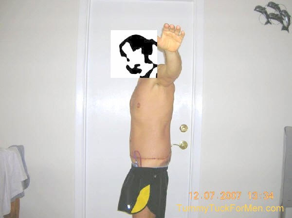 This is a photograph of how I looked from the left 2 days after undergoing Tummy Tuck (Abdominoplasty) Plastic Surgery with Lateral Thigh Lift to remove excess hanging skin from my midsection (having lost over 100 lbs). 