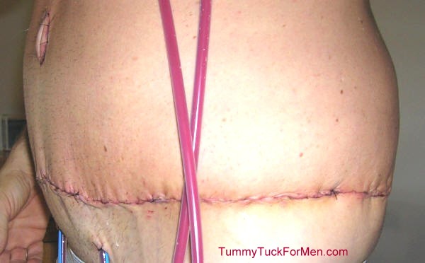 This photograph was taken two days after my tummy tuck with lateral thigh lift operation and shows the obvious swelling and bruising immediately after surgery. You can see how the skin is stretched and sewn together at the incision line. This is a good example of a lateral thigh lift surgery where the surgeon continues the incision to the buttocks area. tummytuckformen.com