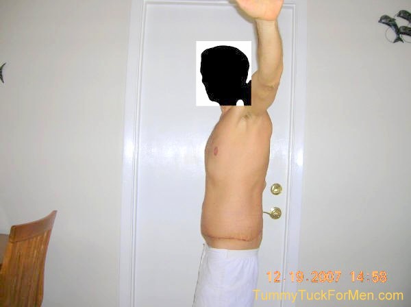 Zoomable "Before" photograph of Tummy Tuck (Abdominoplasty) & Lateral Thigh Lift Surgery to remove sagging skin after a 150 pound weight loss. Tummy Tuck before and after picture gallery. Note the scars and swelling one week after surgery. tummytuckformen.com