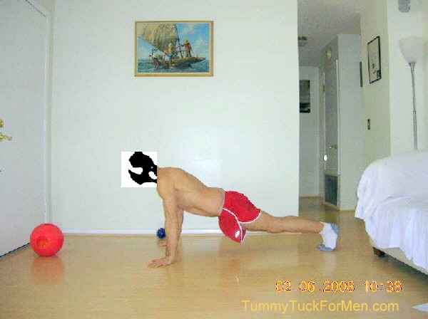 2 months after Tummy Tuck (Abdominoplasty) Surgery doing pushups. tummytuckformen.com