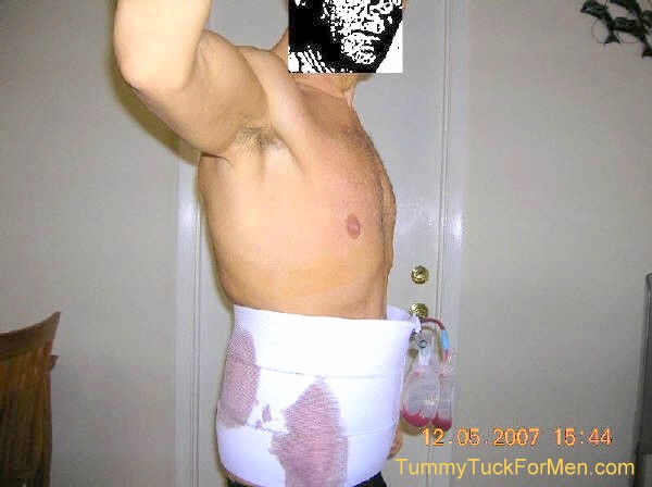 Tummy Tuck (Abdominoplasty) Plastic Surgery Picture - Right Side After 1 Day.  tummytuckformen.com