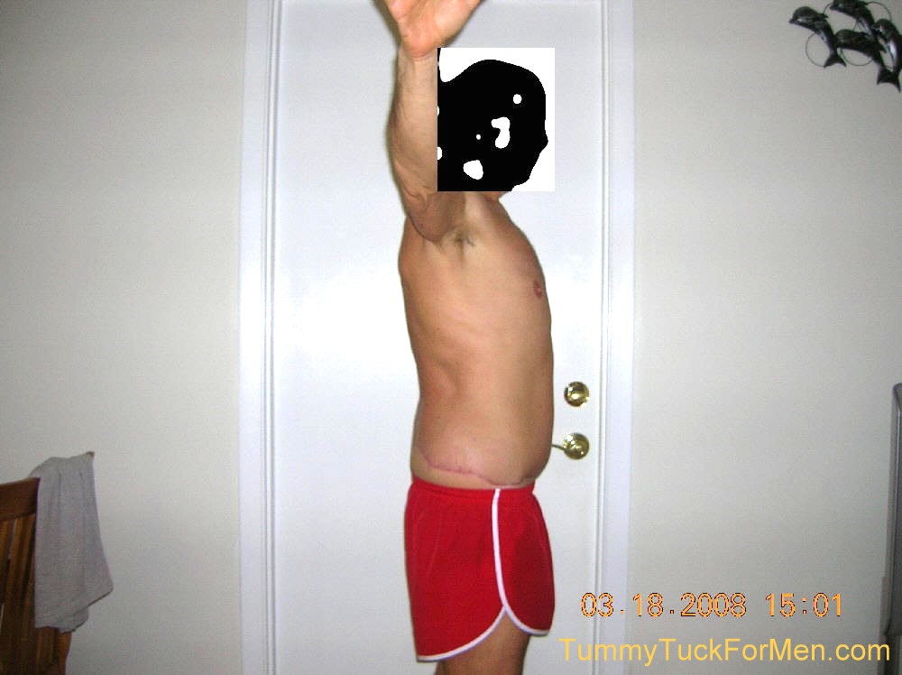 This photograph was taken three months after my tummy tuck with lateral thigh lift operation and shows the uneven incision line area on my back side. Healing was progressing nicely but I was starting to wonder if I still had swelling or if I should have lost 10 pounds more before I the operation. tummytuckformen.com