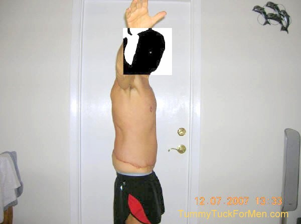 This is a photograph of how I looked from the right 2 days after undergoing Tummy Tuck (Abdominoplasty) Plastic Surgery with Lateral Thigh Lift to remove excess hanging skin from my midsection (having lost over 100 lbs). tummytuckformen.com