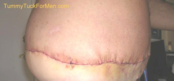 This photograph was taken two days after my tummy tuck with lateral thigh lift operation and shows the obvious swelling and bruising immediately after surgery. You can see how the skin is stretched and sewn together at the incision line. This is a good example of a lateral thigh lift surgery where the surgeon continues the incision to the buttocks area. tummytuckformen.com